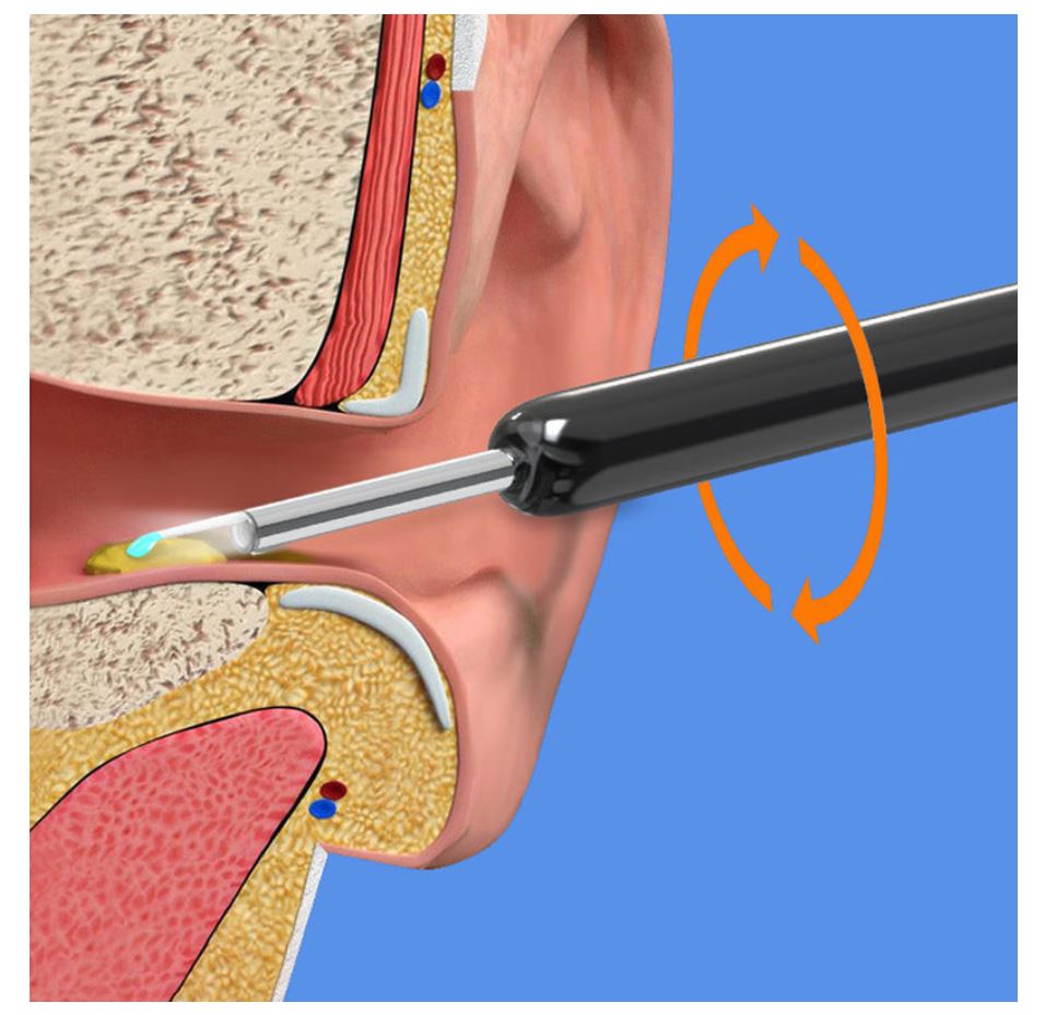 Earwax Removal Kit with HD Camera