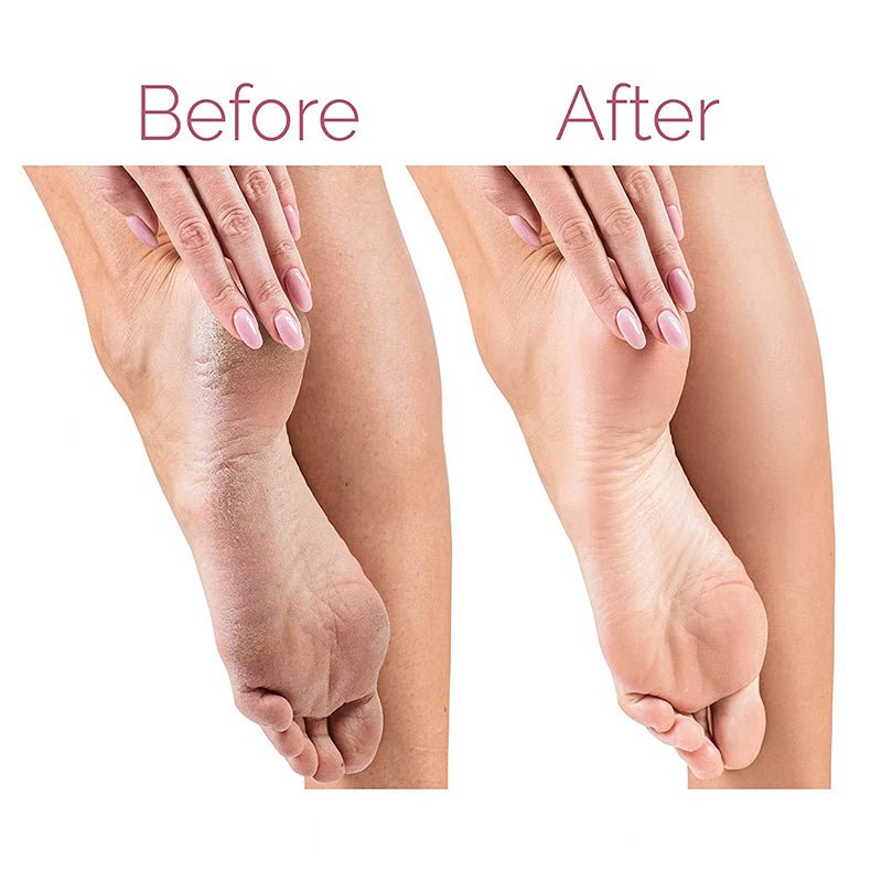 Electric Pedicure Callus Remover